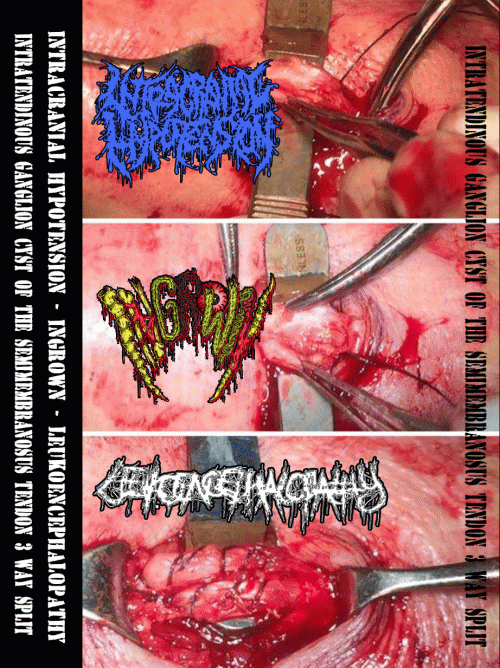 Ingrown (PHL) : Intratendinous Ganglion Cyst of the Semimebranous Tendon 3 Way Split